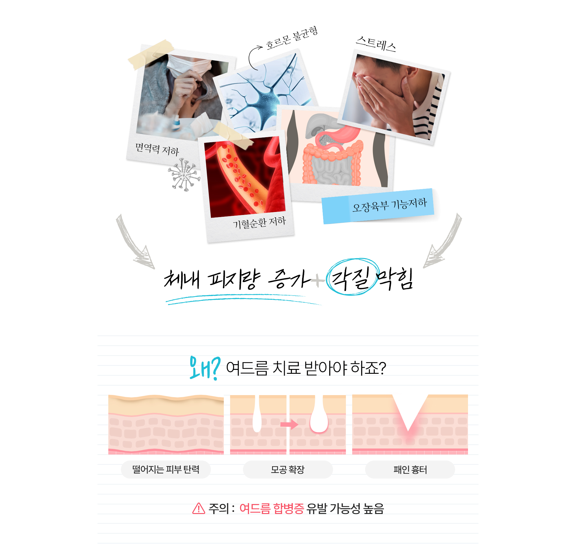 여드름 치료